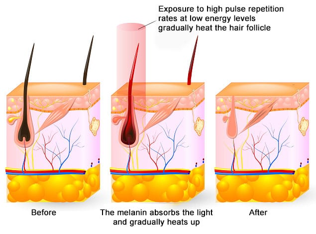 ipl-infograph-v3 – The Global Beauty Group