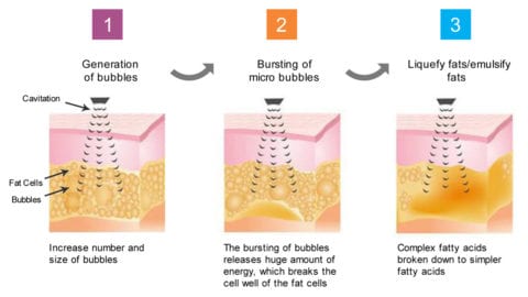 cavitation unoisetion